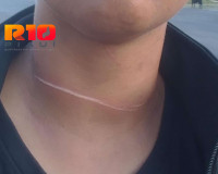 Jovem é ferida por linha com cerol na BR-343 em Piripiri