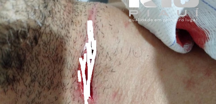 Cerol volta a ferir: motociclista de 37 anos é vítima em Piripiri