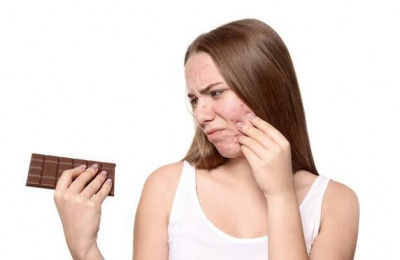 Chocolate dá espinhas? 4 mitos e verdades sobre a acne